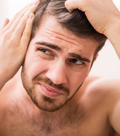 Alopecia androgenética
