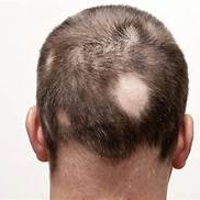 Alopecia areata